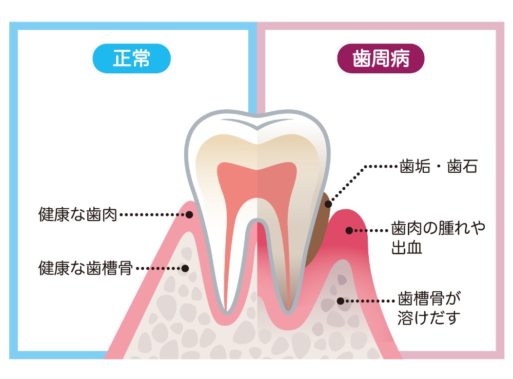 歯周病ってなに？